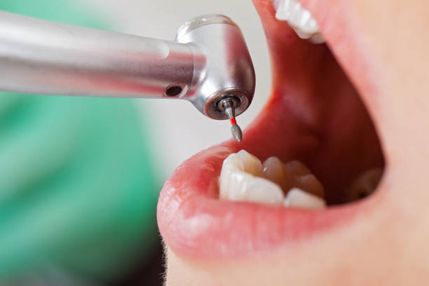 Best Emergency Wisdom Tooth Extraction in Myrtle Point, OR